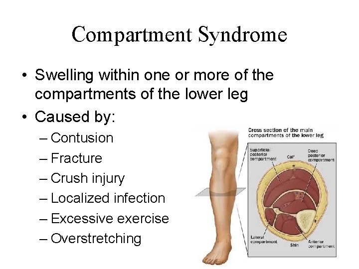 Compartment Syndrome • Swelling within one or more of the compartments of the lower