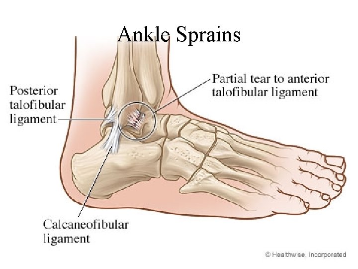Ankle Sprains 