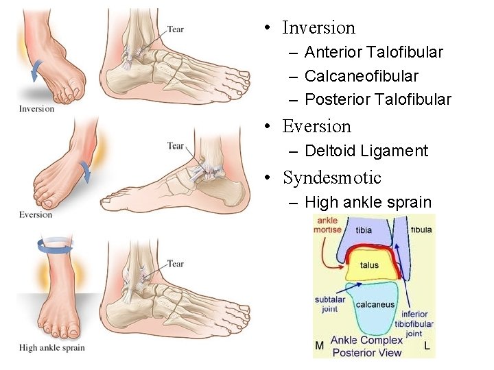  • Inversion – Anterior Talofibular – Calcaneofibular – Posterior Talofibular • Eversion –