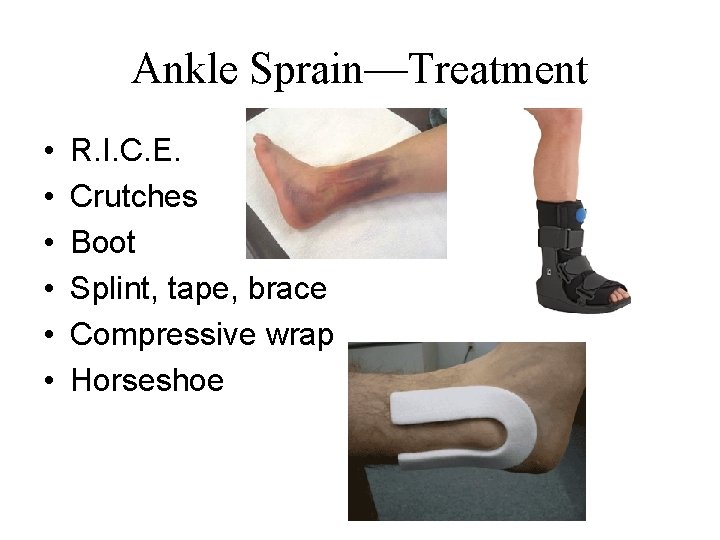 Ankle Sprain—Treatment • • • R. I. C. E. Crutches Boot Splint, tape, brace