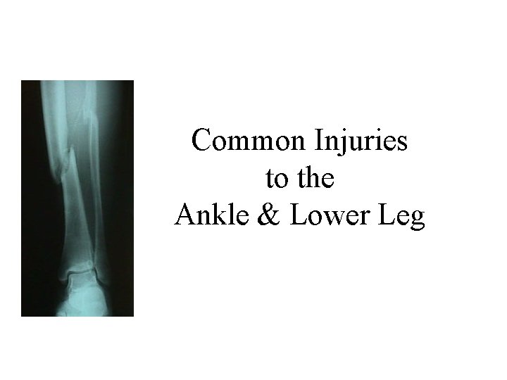 Common Injuries to the Ankle & Lower Leg 