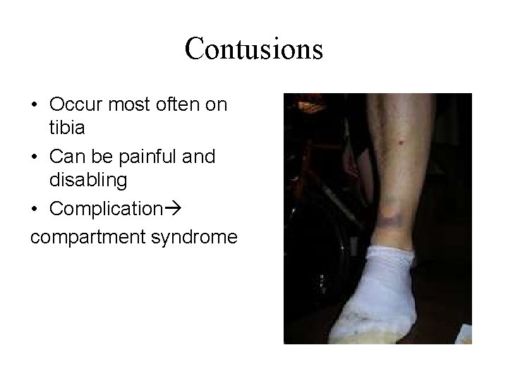 Contusions • Occur most often on tibia • Can be painful and disabling •