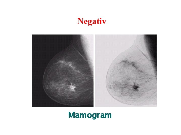 Negativ Mamogram 