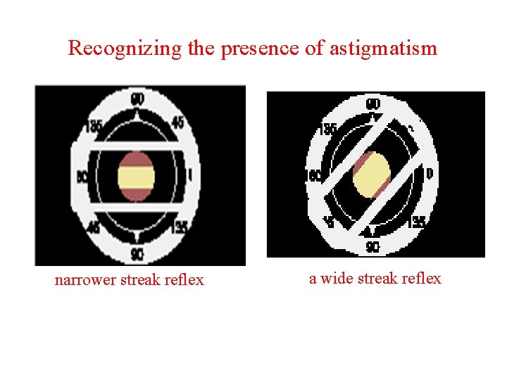 Recognizing the presence of astigmatism narrower streak reflex a wide streak reflex 