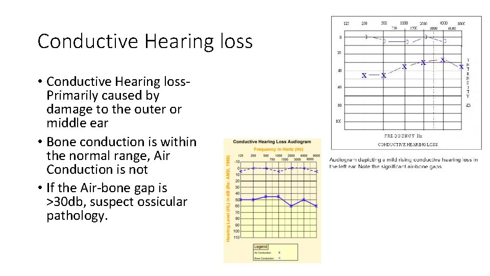 Conductive Hearing loss • Conductive Hearing loss. Primarily caused by damage to the outer Conductive Hearing loss • Conductive Hearing loss. Primarily caused by damage to the outer