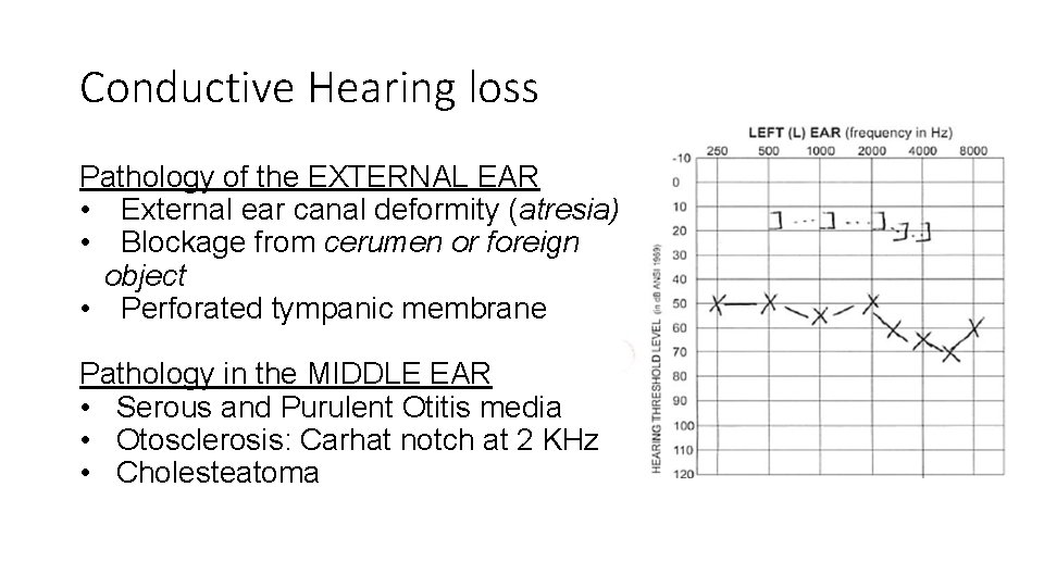 Conductive Hearing loss Pathology of the EXTERNAL EAR • External ear canal deformity (atresia)