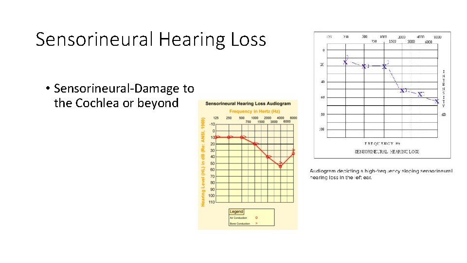 Sensorineural Hearing Loss • Sensorineural-Damage to the Cochlea or beyond Sensorineural Hearing Loss • Sensorineural-Damage to the Cochlea or beyond