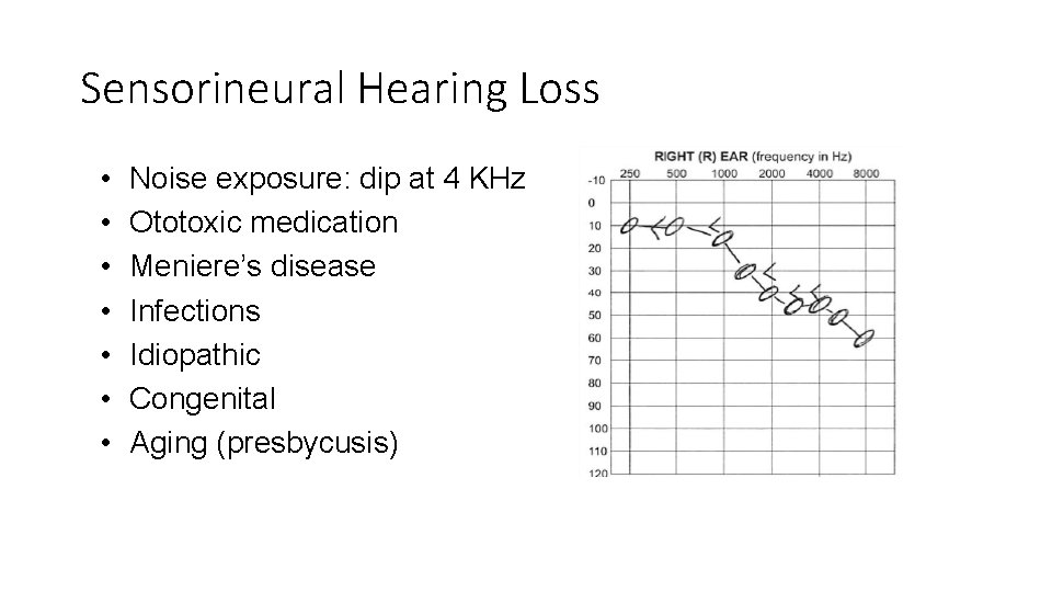 Sensorineural Hearing Loss • • Noise exposure: dip at 4 KHz Ototoxic medication Meniere’s