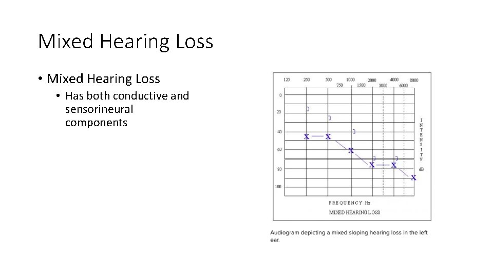 Mixed Hearing Loss • Has both conductive and sensorineural components Mixed Hearing Loss • Has both conductive and sensorineural components