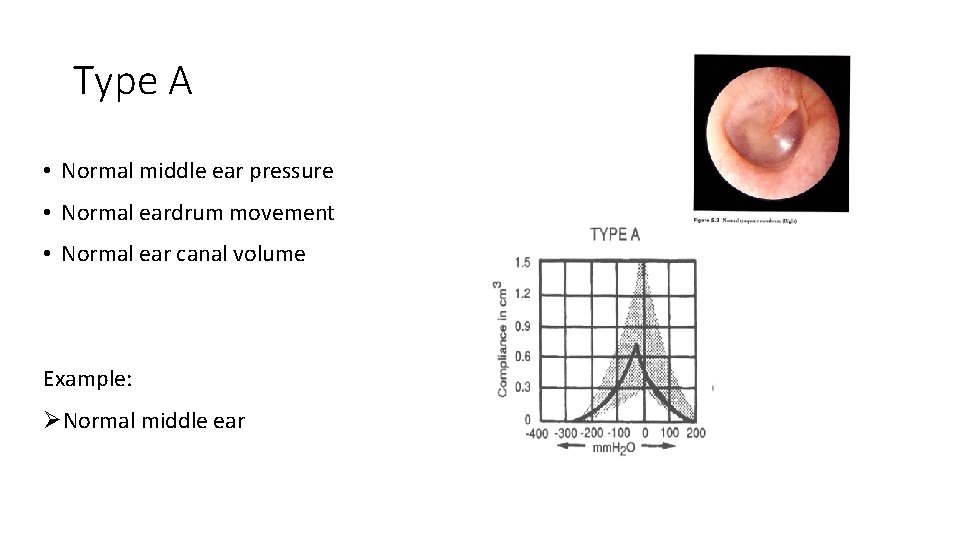 Type A • Normal middle ear pressure • Normal eardrum movement • Normal ear