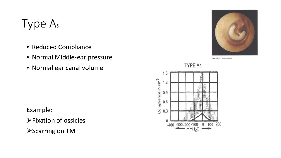 Type As • Reduced Compliance • Normal Middle-ear pressure • Normal ear canal volume Type As • Reduced Compliance • Normal Middle-ear pressure • Normal ear canal volume