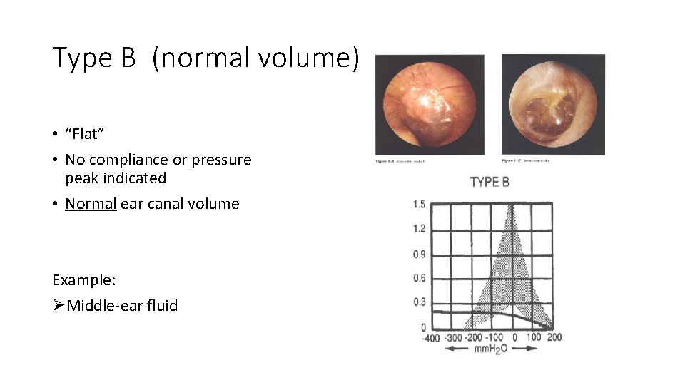 Type B (normal volume) • “Flat” • No compliance or pressure peak indicated • Type B (normal volume) • “Flat” • No compliance or pressure peak indicated •