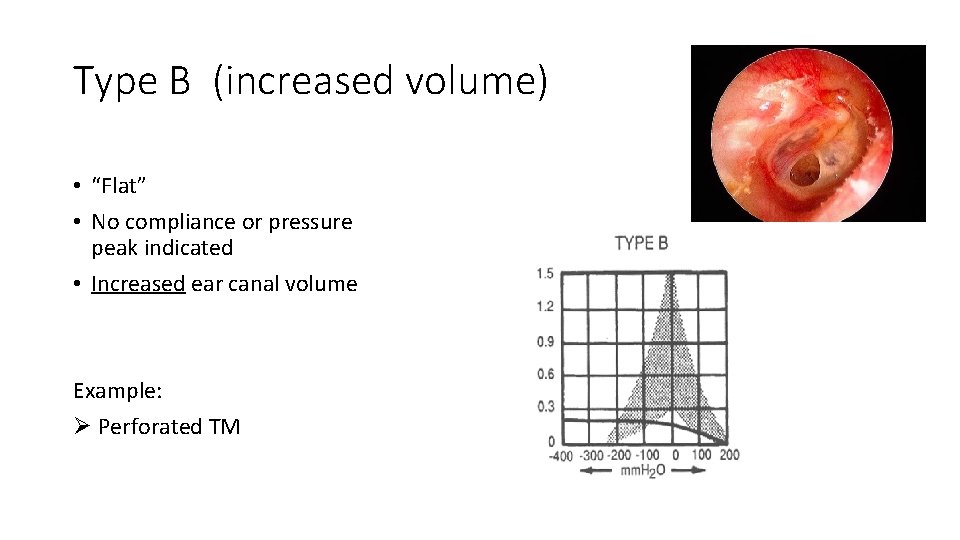 Type B (increased volume) • “Flat” • No compliance or pressure peak indicated • Type B (increased volume) • “Flat” • No compliance or pressure peak indicated •