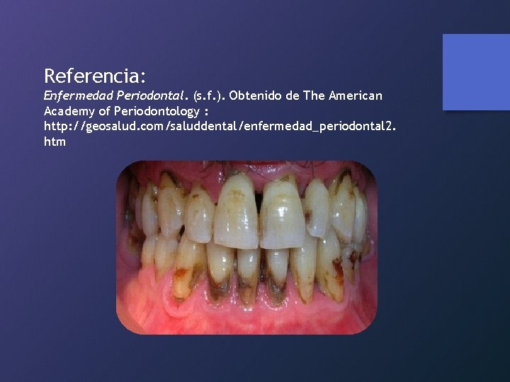 Referencia: Enfermedad Periodontal. (s. f. ). Obtenido de The American Academy of Periodontology :