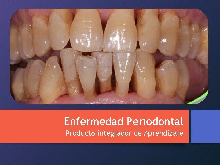 Enfermedad Periodontal Producto integrador de Aprendizaje 