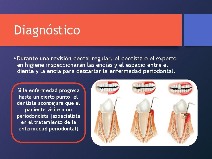 Diagnóstico • Durante una revisión dental regular, el dentista o el experto en higiene