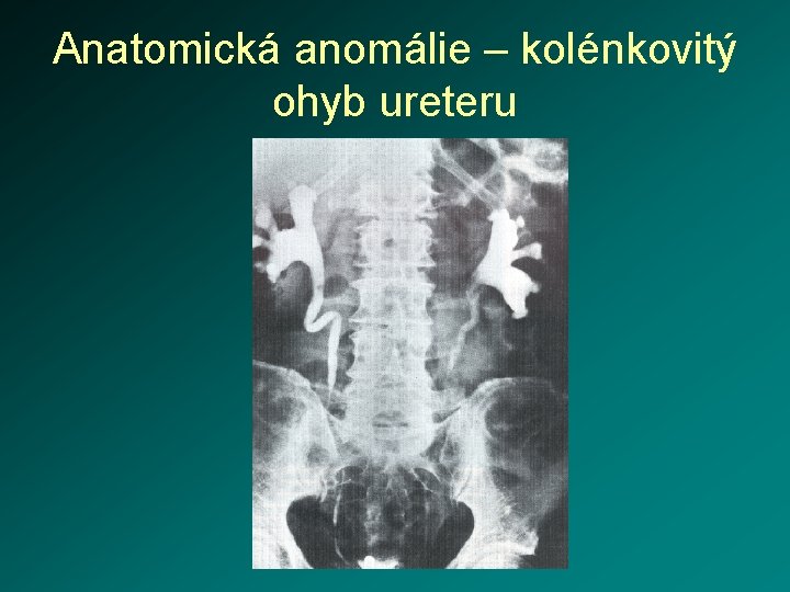 Anatomická anomálie – kolénkovitý ohyb ureteru 