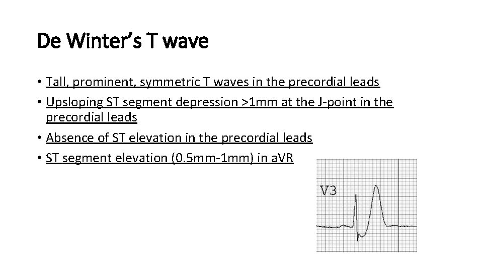 De Winter’s T wave • Tall, prominent, symmetric T waves in the precordial leads