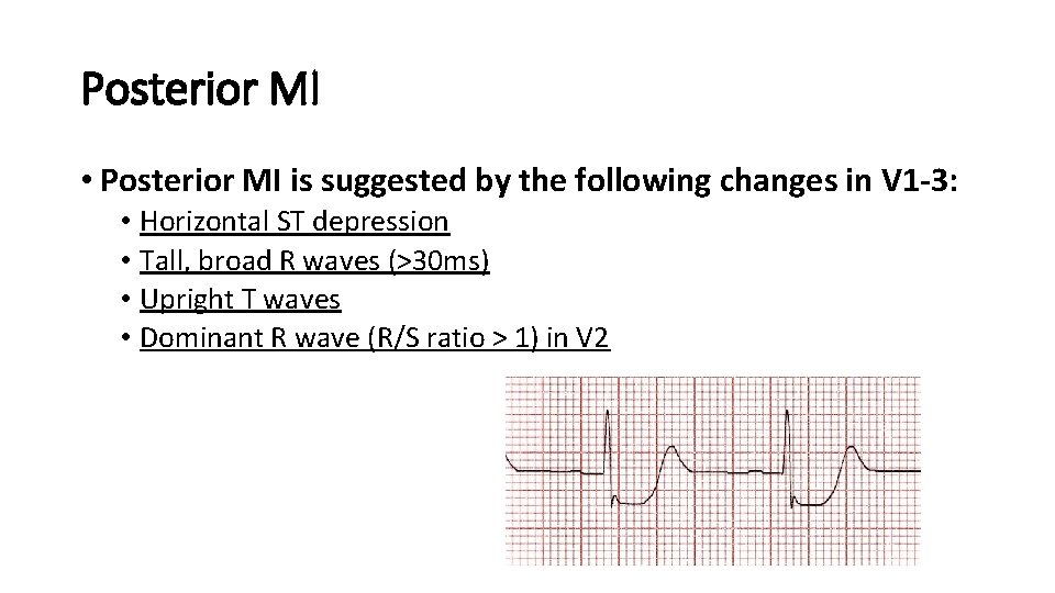 Posterior MI • Posterior MI is suggested by the following changes in V 1