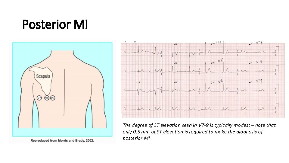 Posterior MI The degree of ST elevation seen in V 7 -9 is typically