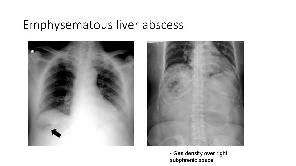 Emphysematous liver abscess - Gas density over right subphrenic space 