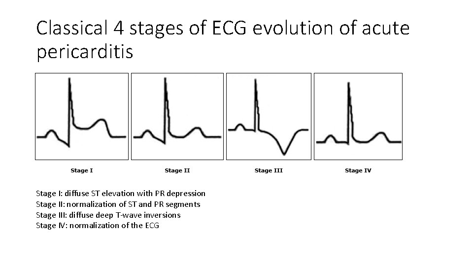 Classical 4 stages of ECG evolution of acute pericarditis Stage I: diffuse ST elevation