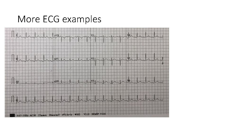 More ECG examples 