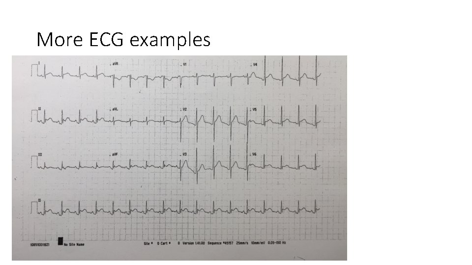 More ECG examples 