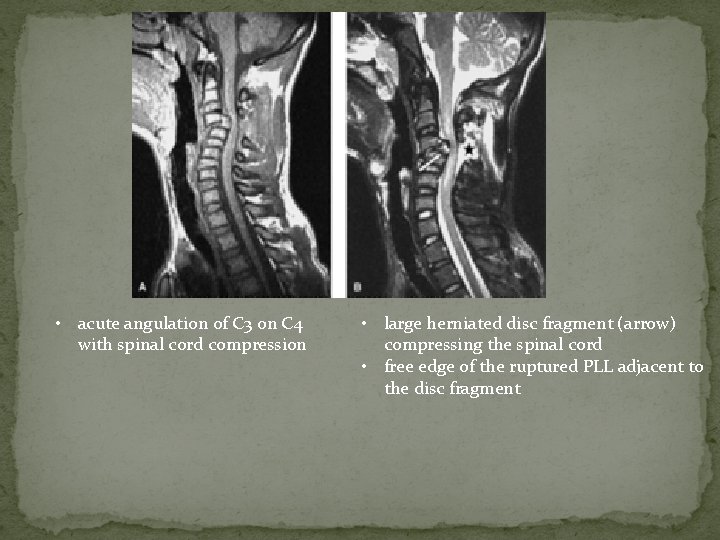  • acute angulation of C 3 on C 4 with spinal cord compression