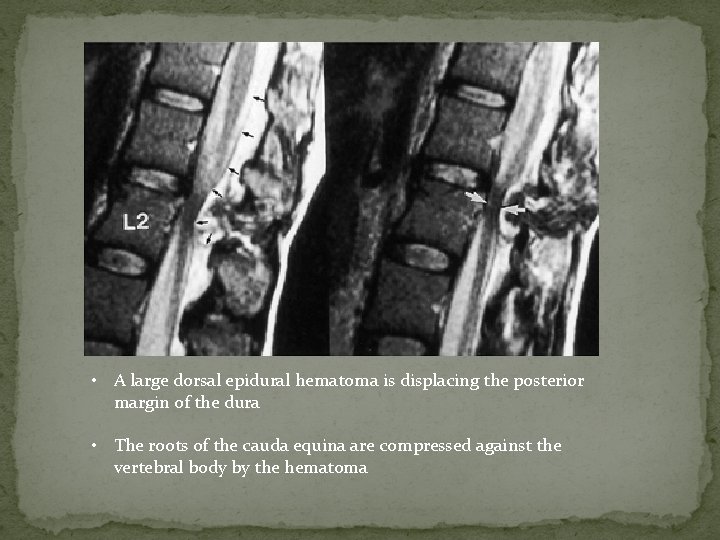  • A large dorsal epidural hematoma is displacing the posterior margin of the