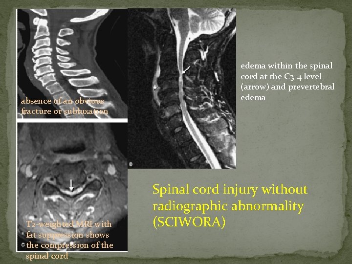 absence of an obvious fracture or subluxation T 2 -weighted MRI with fat suppression