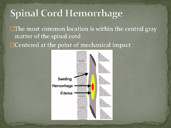 Spinal Cord Hemorrhage �The most common location is within the central gray matter of
