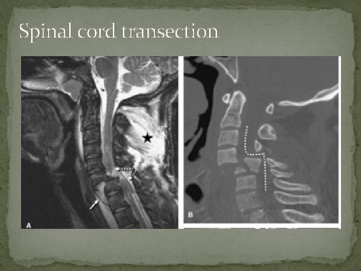 Spinal cord transection 