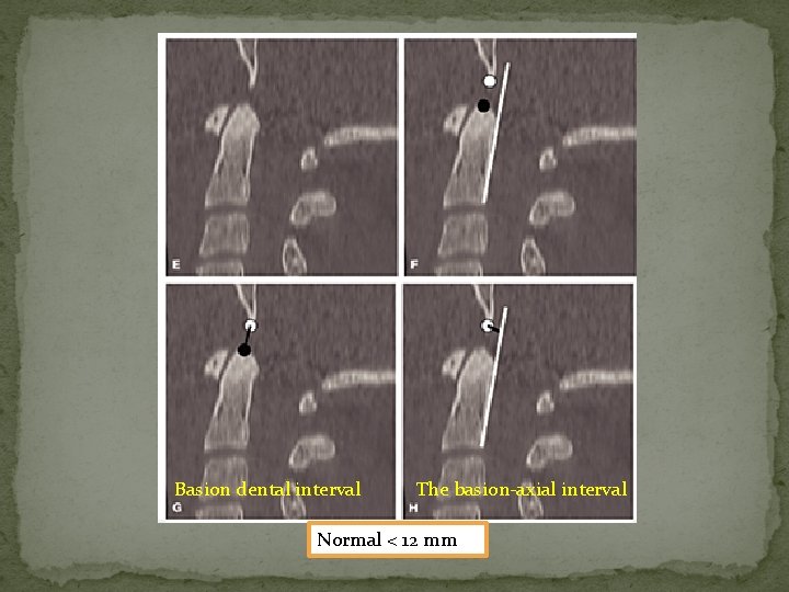 Basion dental interval The basion-axial interval Normal < 12 mm 