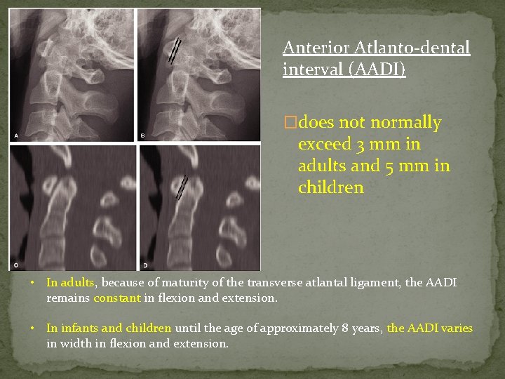 Anterior Atlanto-dental interval (AADI) �does not normally exceed 3 mm in adults and 5