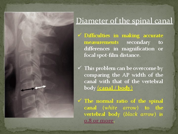 Diameter of the spinal canal ü Difficulties in making accurate measurements secondary to differences
