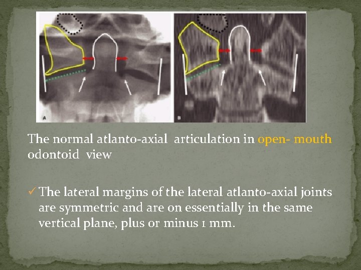 The normal atlanto-axial articulation in open- mouth odontoid view ü The lateral margins of