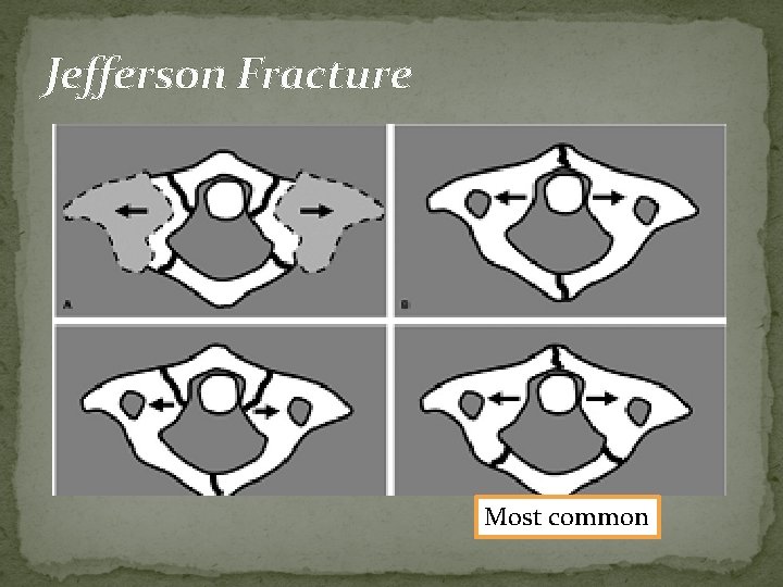 Jefferson Fracture Most common 