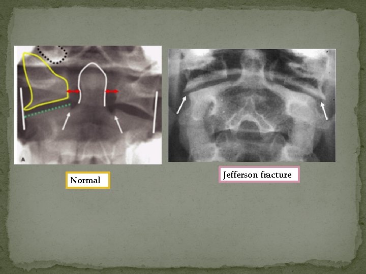 Normal Jefferson fracture 