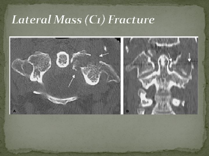 Lateral Mass (C 1) Fracture 