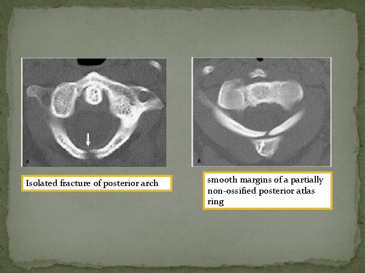 Isolated fracture of posterior arch smooth margins of a partially non-ossified posterior atlas ring