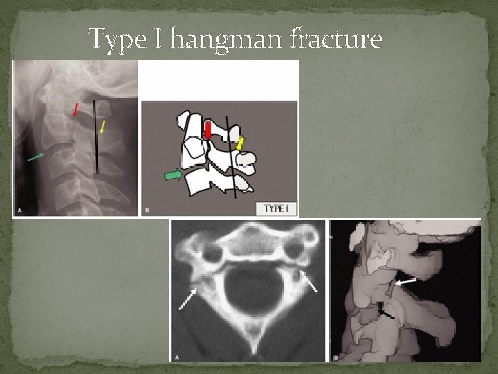 Type I hangman fracture 