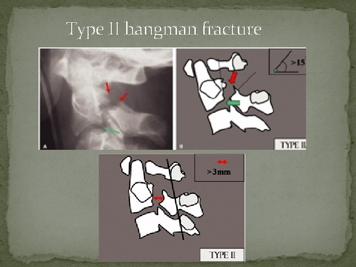 Type II hangman fracture 