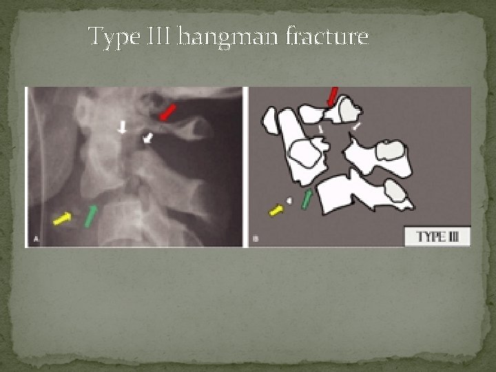 Type III hangman fracture 