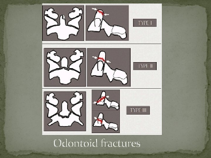 Odontoid fractures 
