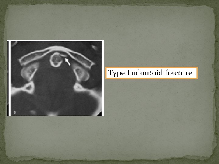 Type I odontoid fracture 