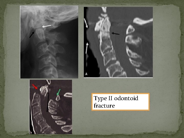 Type II odontoid fracture 