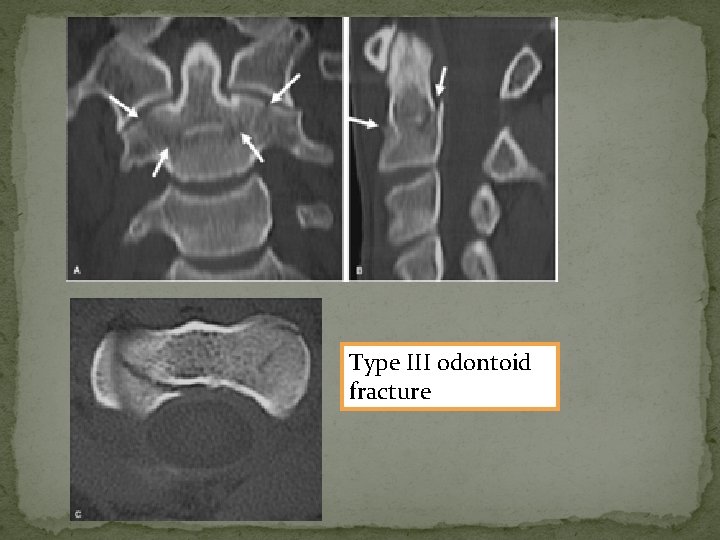 Type III odontoid fracture 