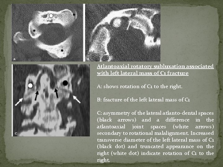 Atlantoaxial rotatory subluxation associated with left lateral mass of C 1 fracture A: shows