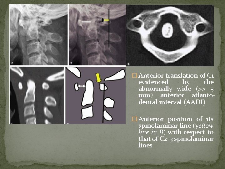 � Anterior translation of C 1 evidenced by the abnormally wide (>> 5 mm)